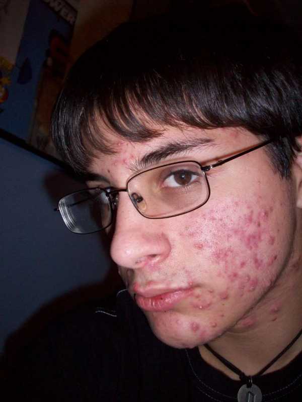 acne-cystic-face.jpg