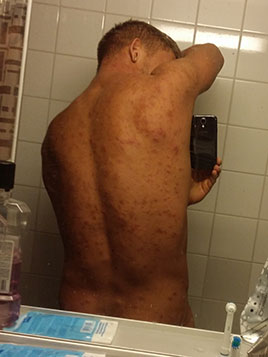 Good loser accutane looking